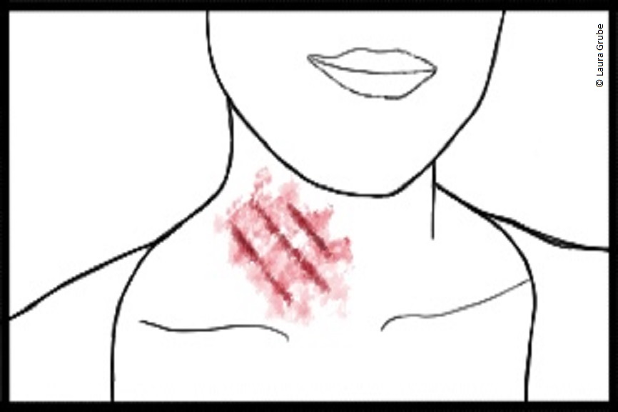 Der Hals einer illustrierten Person. Am Hals sind rote Streifen zu sehen.